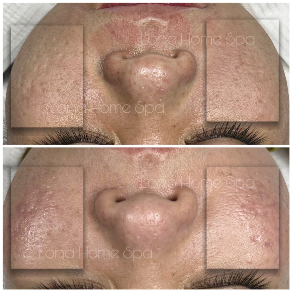 Quá trình tái tạo da và điều trị sẹo hỗn hợp hiệu quả tại Lona Skin Lab