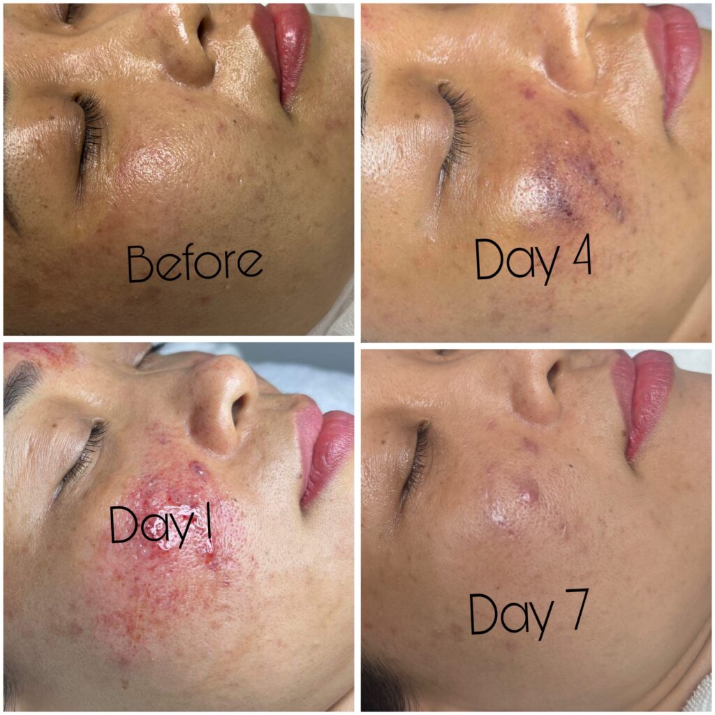 Hình ảnh kết quả điều trị sẹo hỗn hợp thể hiện sự cải thiện rõ rệt ở da tại Lona Skin Lab