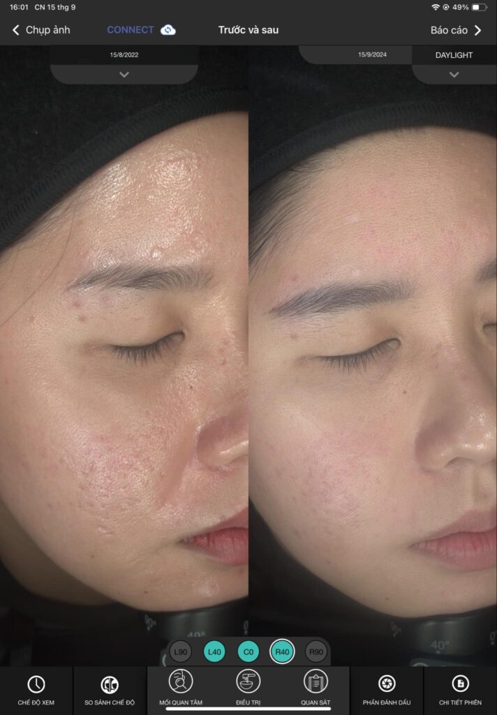 Hình ảnh thể hiện nguyên tắc phòng sẹo mụn và ngăn ngừa sẹo mụn qua phương pháp sẹo mụn phòng dễ hơn trị