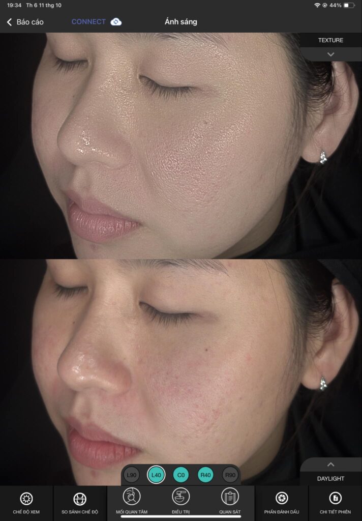Hình ảnh cho thấy quá trình trị sẹo mụn thông qua các liệu trình tại Lona Skin Lab, với sẹo mụn phòng dễ hơn trị