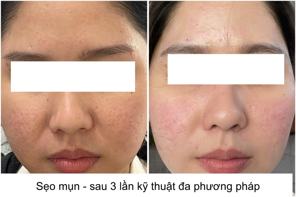 Trong giai đoạn hậu mụn, việc xử lý khiếm khuyết sau mụn đòi hỏi sự kết hợp giữa phục hồi da sau mụn chuyên sâu, trị sẹo mụn cẩn thận và tái cấu trúc da nhằm đem lại kết quả tối ưu.