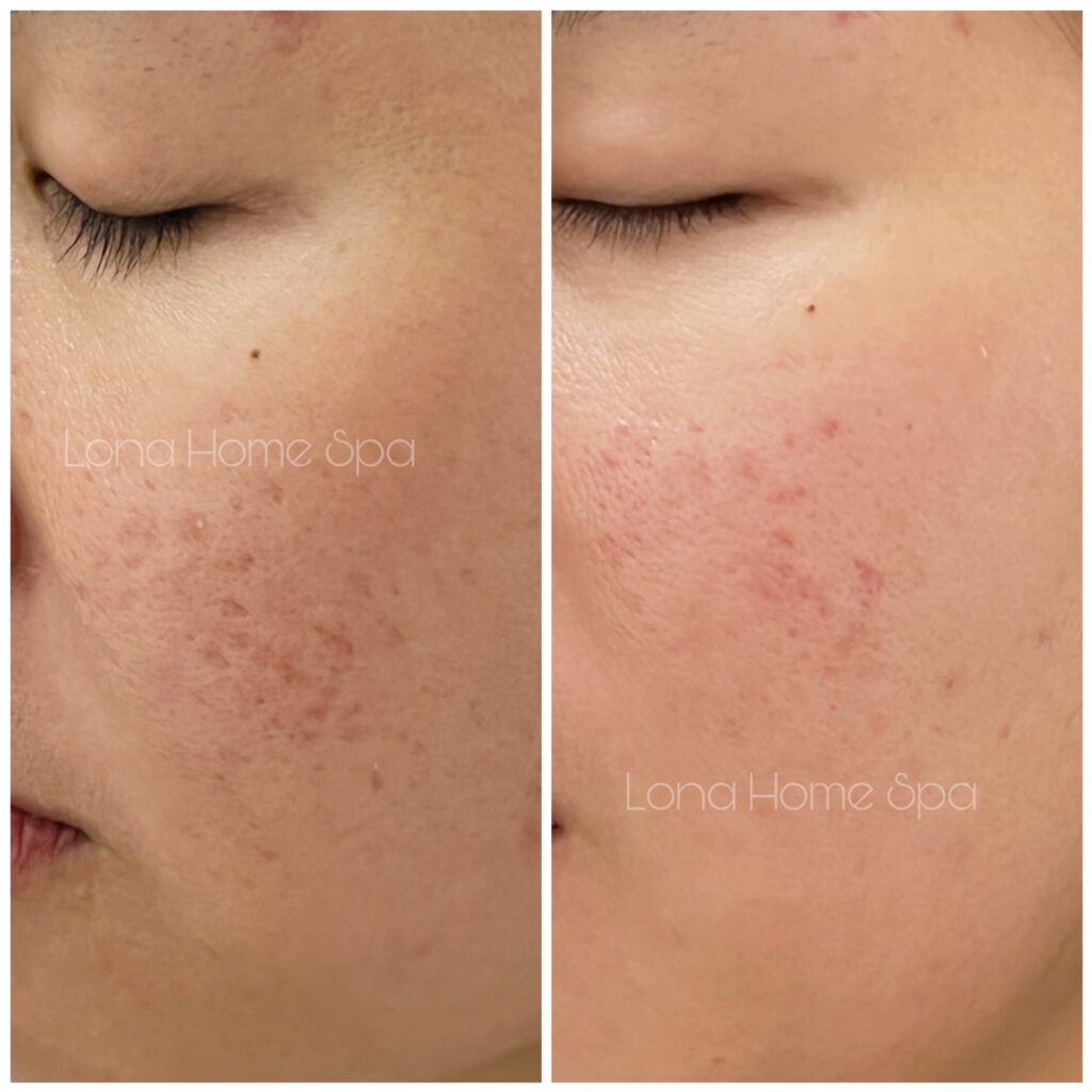 Hình ảnh trước và sau khi trị sẹo rỗ bằng phương pháp hiện đại