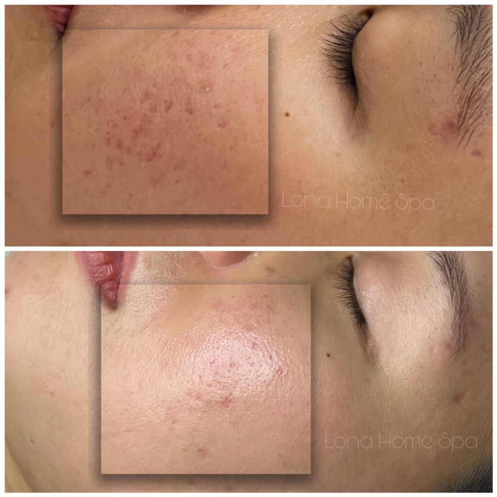 Quy trình phòng sẹo mụn hiệu quả với sẹo mụn phòng dễ hơn trị, áp dụng phương pháp phòng sẹo mụn và ngăn ngừa sẹo mụn từ mụn viêm tại Lona Skin Lab