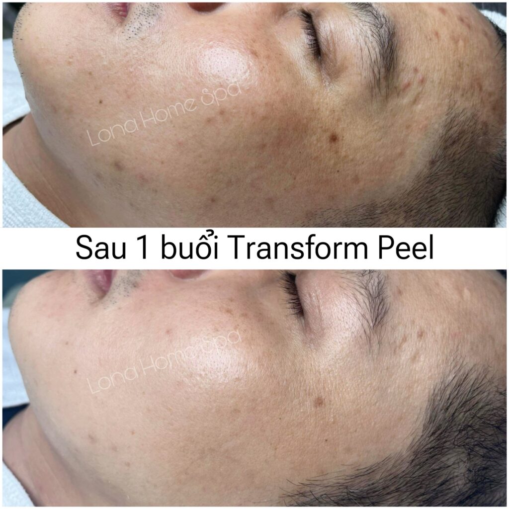 Minh họa quá trình peel da trị sẹo rỗ bằng cách tái tạo làn da hiệu quả, nêu bật ưu nhược điểm của peel da trong điều trị sẹo rỗ.