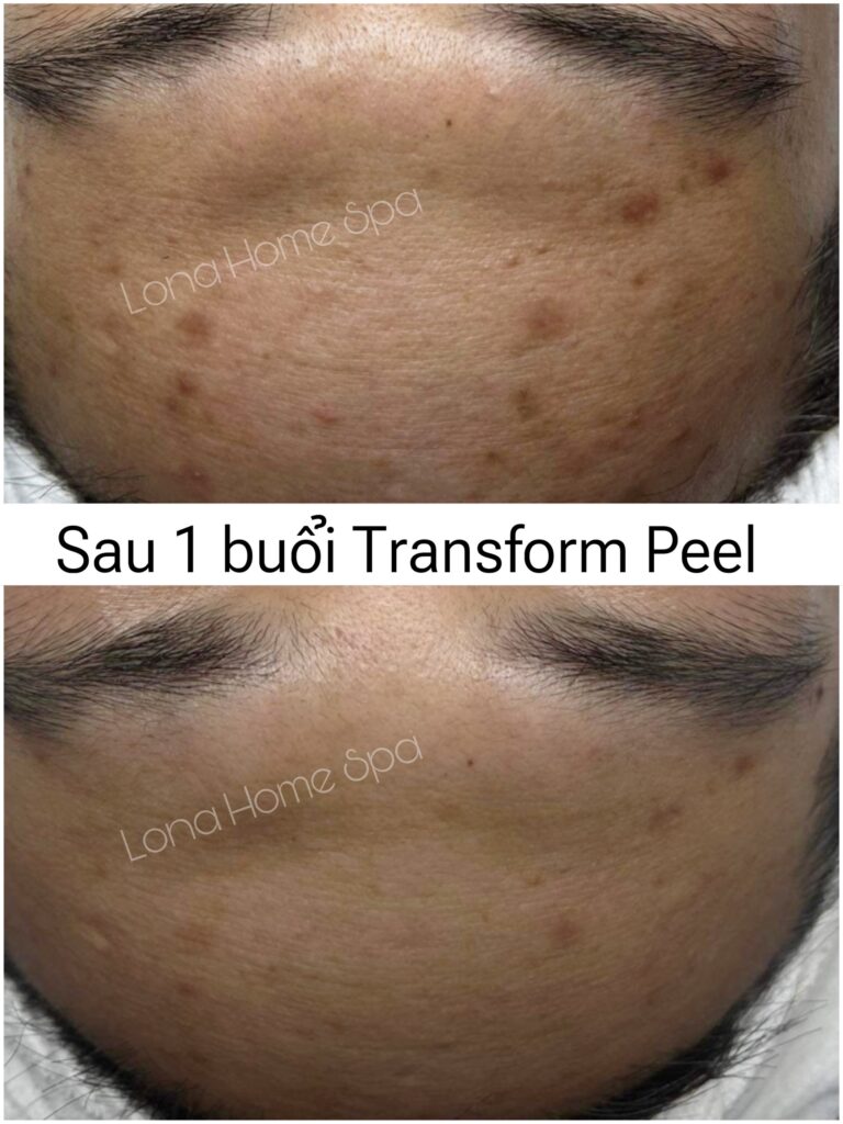 Liệu pháp peel da hiện đại, do bác sĩ trị nám Cần Thơ chỉ đạo, đã giúp cải thiện sắc tố và xóa tan vết nám, diễn giải sự chuyên môn của bác sĩ da liễu trị nám giỏi Cần Thơ.