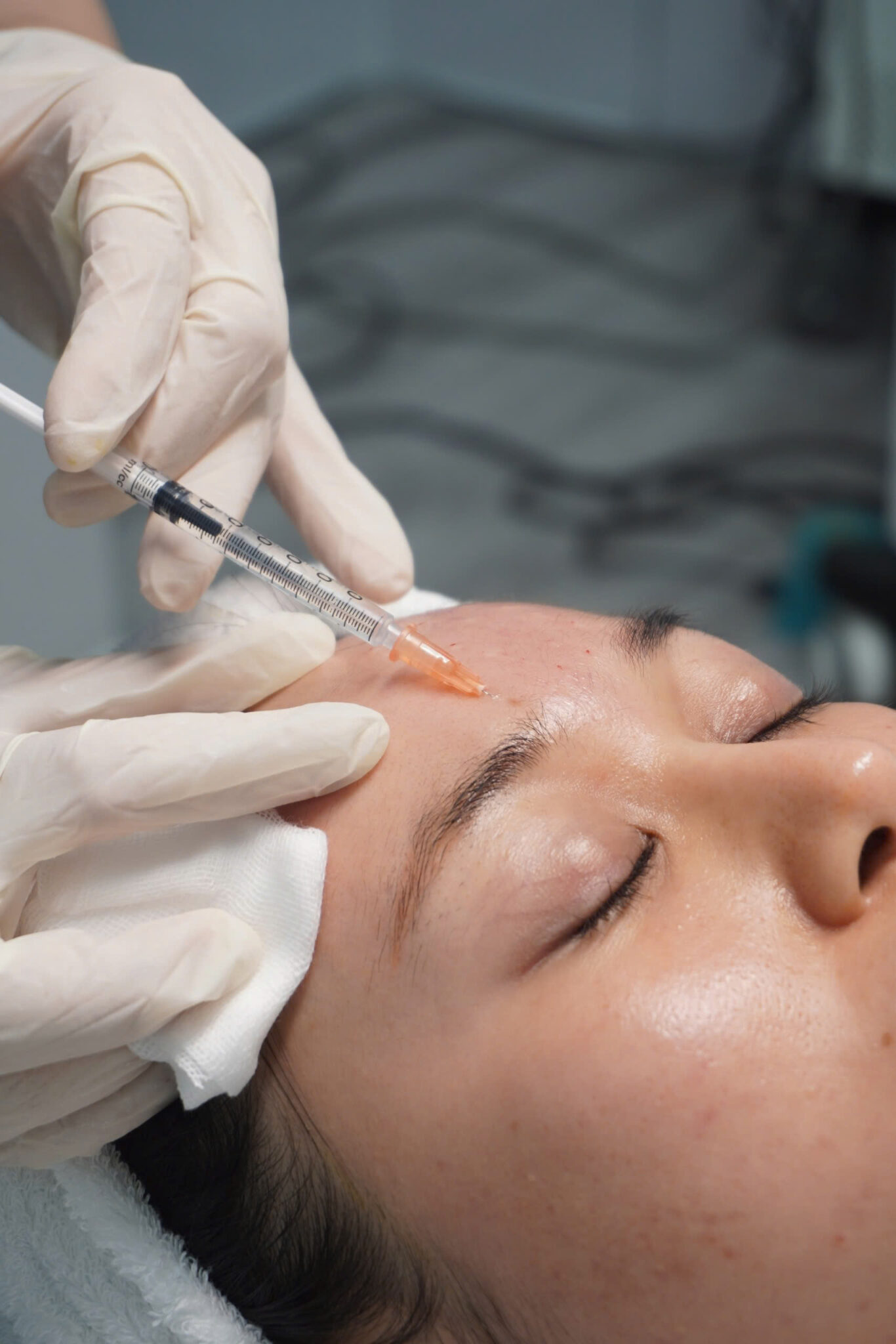 Trong hình 'botox_cau_mày_02', công nghệ xóa nhăn li ti toàn mặt được áp dụng bởi Lona Skin Lab qua quy trình tiêm botox xóa nhăn tỉ mỉ, giúp trẻ hóa da bằng botox và khẳng định dịch vụ botox tại Lona Skin Lab luôn đạt chất lượng cao.