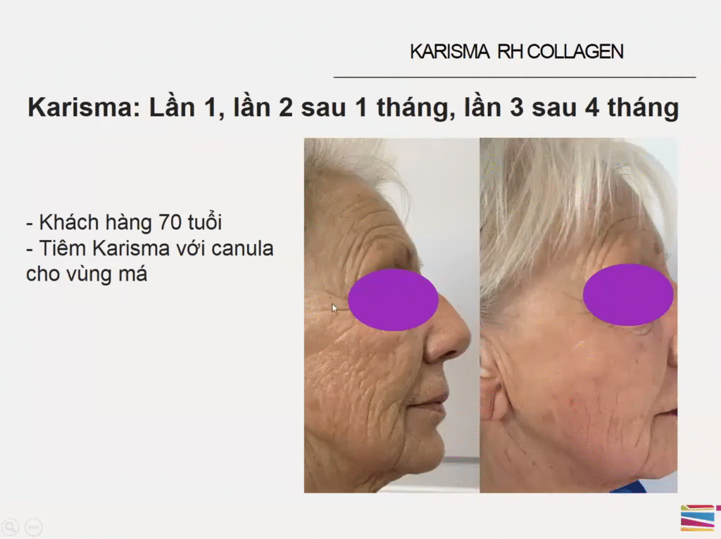 Trải nghiệm lâm sàng của Karisma Rh Collagen: hình ảnh phục hồi nền da mỏng tuổi trung niên bằng Karisma, minh chứng cho quá trình Collagen Tái Tổ Hợp và khái niệm ‘KARISMA là gì?’ trong chăm sóc da chuyên sâu.