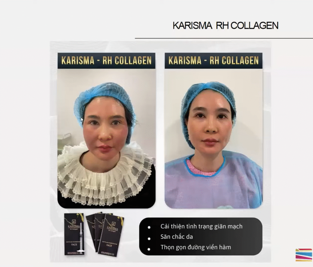 Hình ảnh thực tế cho thấy Tiêm Karisma có tác dụng không với vùng cằm khi cải thiện nếp gấp, trong khi Tiêm Karisma vùng cằm giúp đồng bộ quá trình tái tạo collagen.
