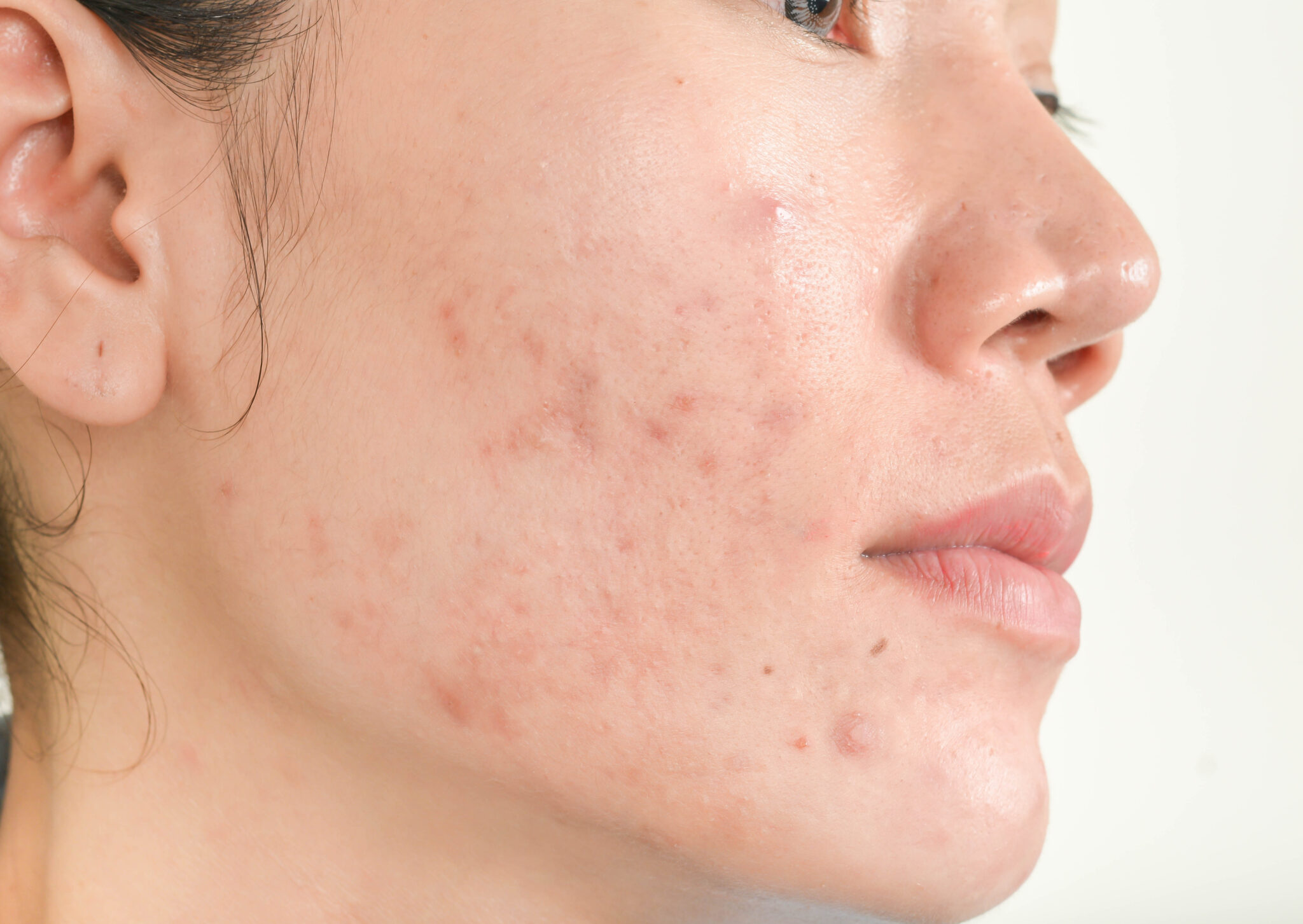 Các chuyên gia da liễu khuyến cáo rằng việc nhận biết mụn trứng cá đỏ qua triệu chứng mụn trứng cá đỏ có thể giúp phân biệt nó với mụn trứng cá thường, nhấn mạnh sự khác biệt giữa mụn trứng cá đỏ và mụn trứng cá thường, đồng thời hiểu đúng nguyên nhân mụn trứng cá đỏ để điều trị hiệu quả.