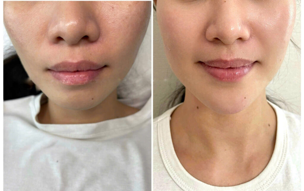 Hình ảnh về công nghệ xóa nhăn và thẩm mỹ 2025 với Ultherapy Maxpro 2025, HIFU tại Lona Skin Lab