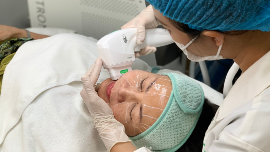Minh họa Ultherapy Maxpro 2025 trong công nghệ xóa nhăn hiện đại