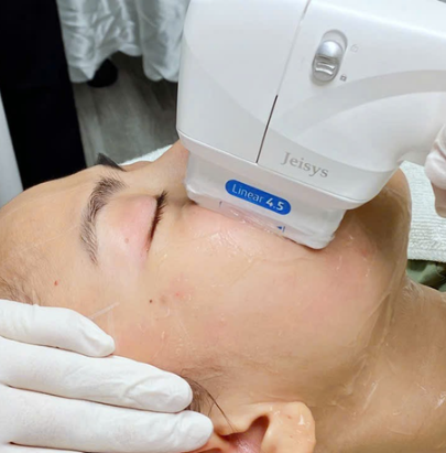 Kỹ thuật trẻ hóa da tại Cần Thơ qua công nghệ HIFU kết hợp tiêm Meso, mang lại kết quả trẻ trung và căng mịn.