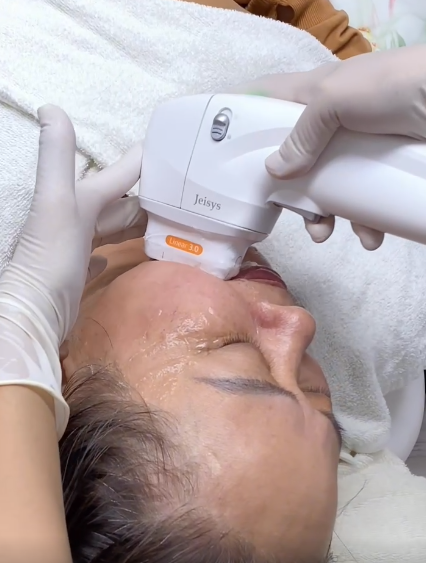 nâng cơ da mặt, HIFU, Lona Skin Lab, trẻ hóa da tự nhiên, công nghệ HIFU