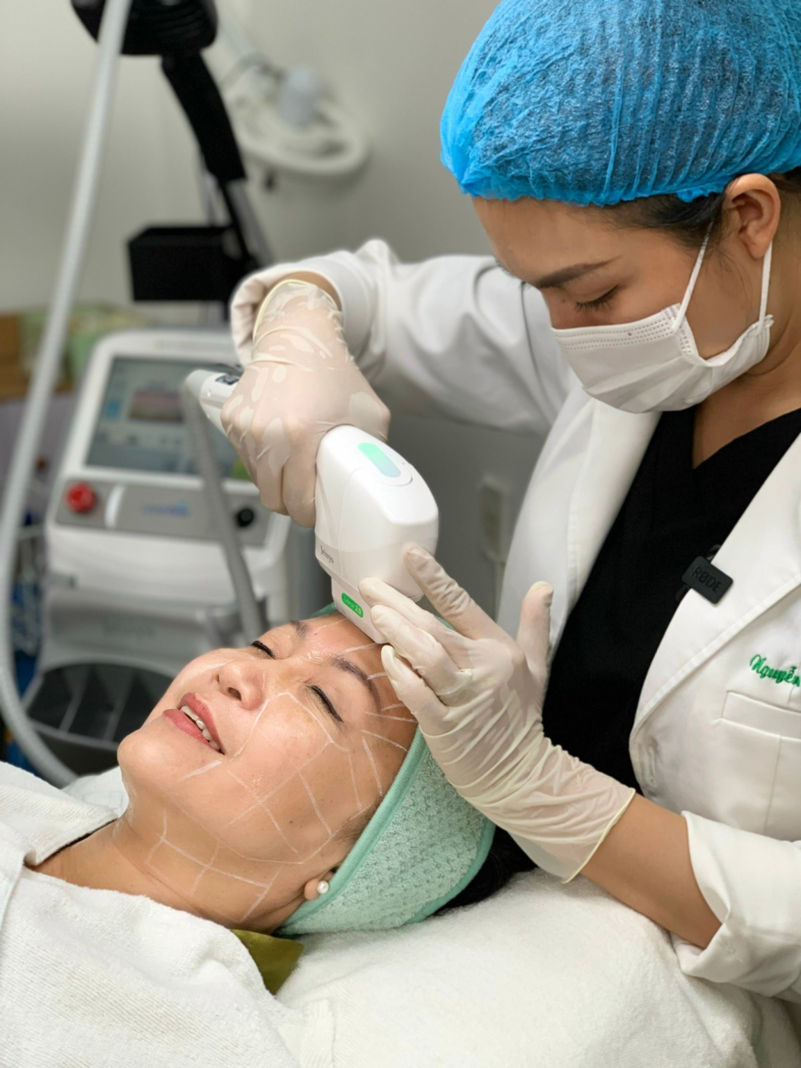 Trong bối cảnh giãn mao mạch ở mặt, hình ảnh này minh họa dấu hiệu giãn mao mạch da mặt rõ rệt và liên quan đến triệu chứng giãn mao mạch.