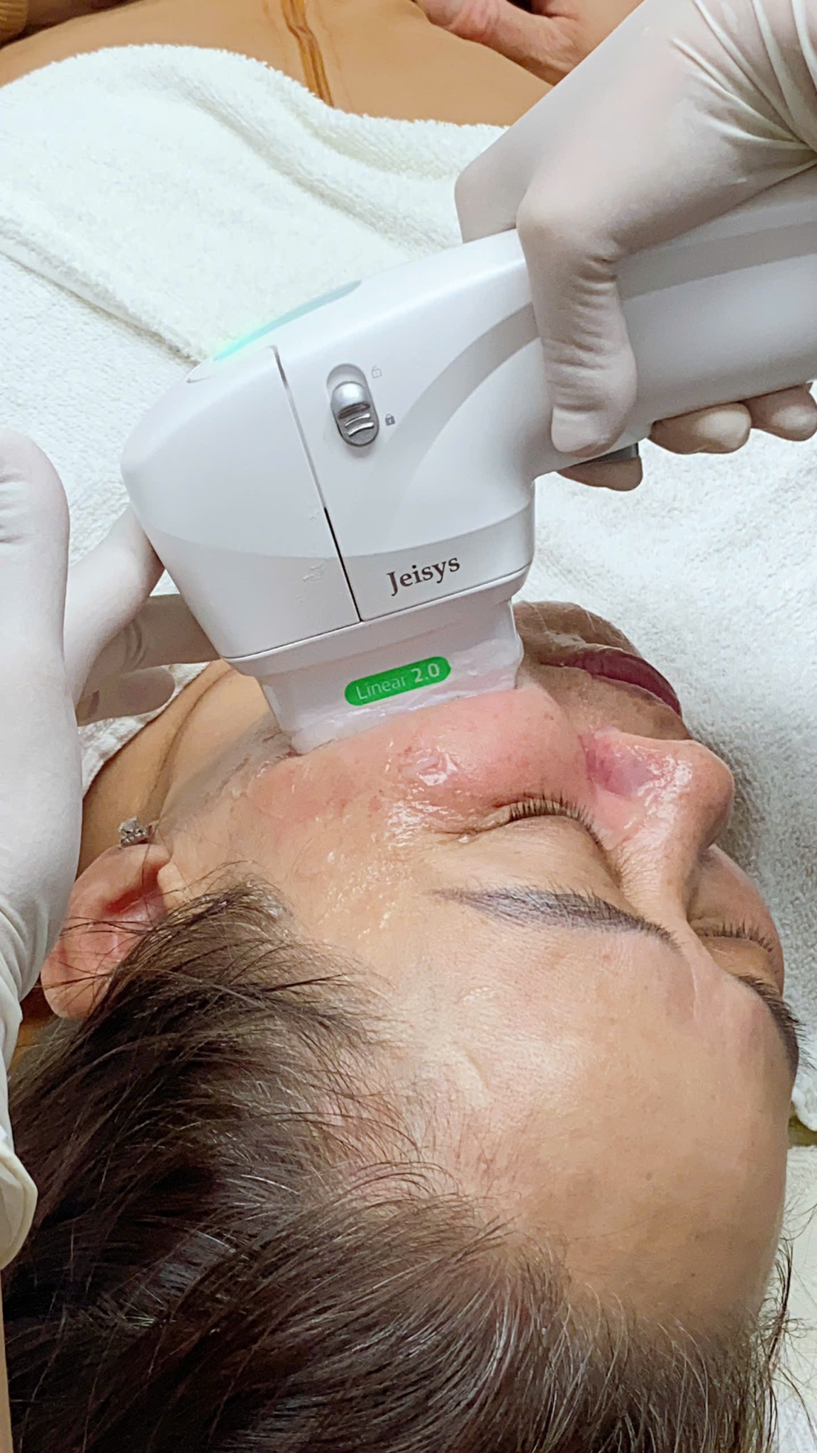 Hình ảnh HIFU mặt phản ánh chi phí HIFU hợp lý và hiệu quả điều trị