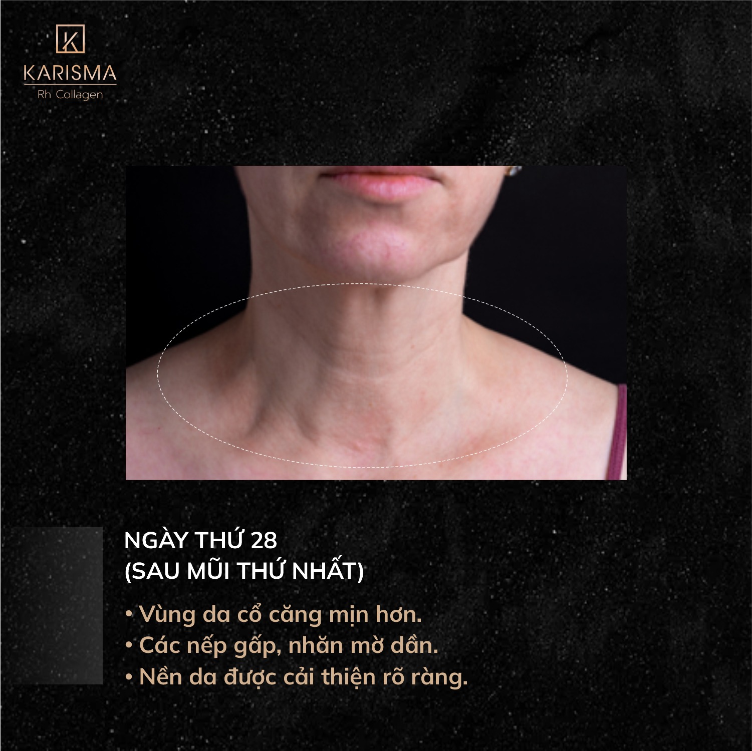 Hình ảnh cho thấy sự hội tụ của Karisma và tiêm bap karisma sáng tạo, khẳng định karisma công dụng cá tính, đáp ứng câu hỏi karisma của nước nào, và cho điểm tiêm karisma tối ưu qua karisma rh collagen.