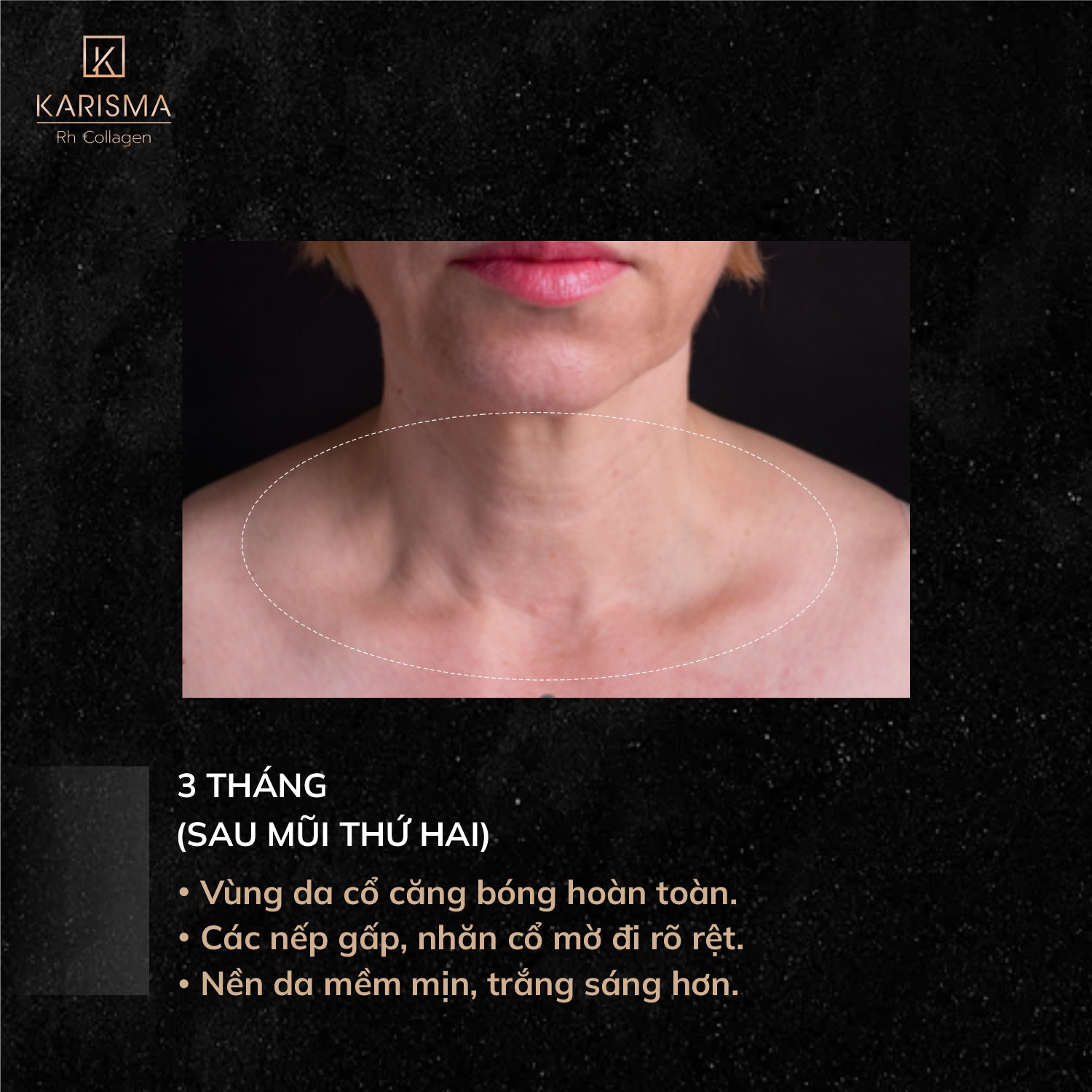 Bức ảnh cuối cùng vinh danh Karisma khi tiêm bap karisma được áp dụng, khẳng định karisma công dụng tiên phong, khám phá karisma của nước nào nổi bật, và ghi nhận điểm tiêm karisma xuất sắc qua karisma rh collagen.