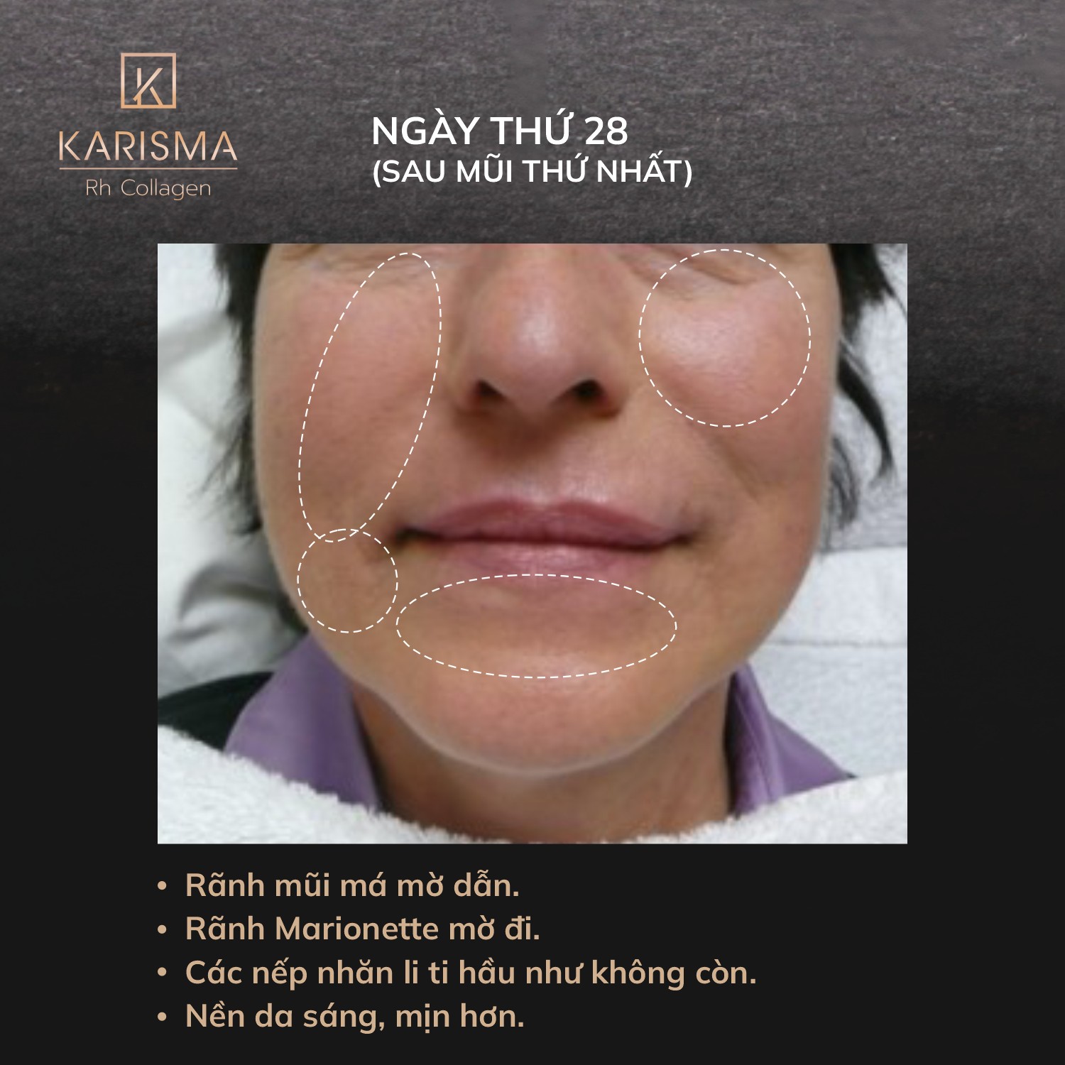 Qua hình ảnh này, Karisma cùng tiêm bap karisma thể hiện sự hoàn hảo, minh chứng karisma công dụng đa dạng và mở ra insight về karisma của nước nào, đạt điểm tiêm karisma tiên tiến qua karisma rh collagen.