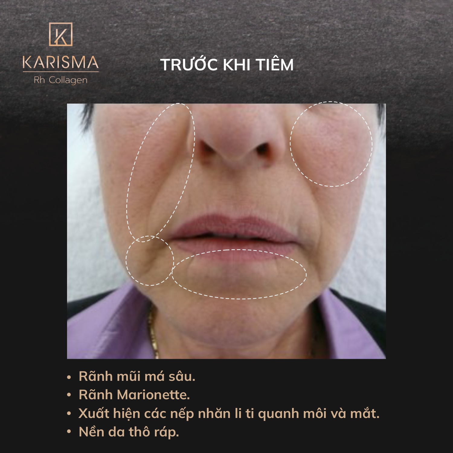 Bức hình truyền cảm hứng với Karisma khi tiêm bap karisma đầy đột phá, thể hiện karisma công dụng tiện ích, khám phá karisma của nước nào hiệu quả, và đạt điểm tiêm karisma ấn tượng qua karisma rh collagen.