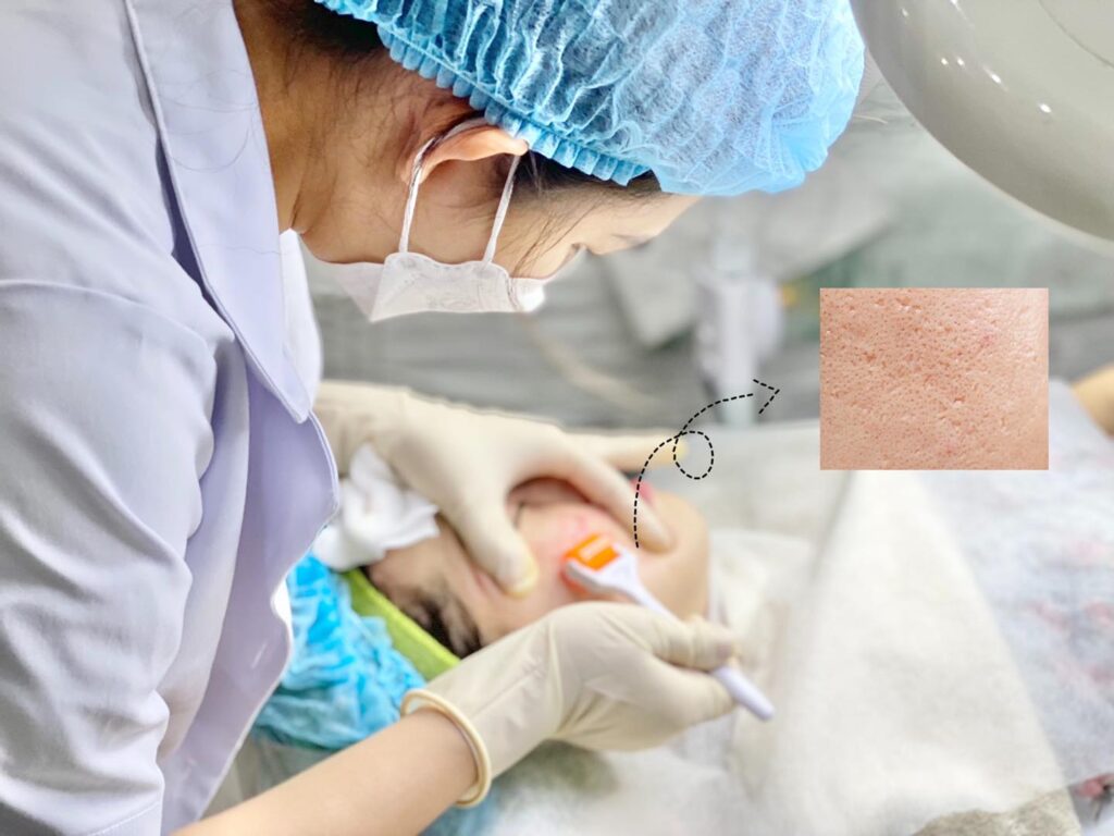 Quy trình lăn kim kết hợp RF trong trị sẹo rỗ