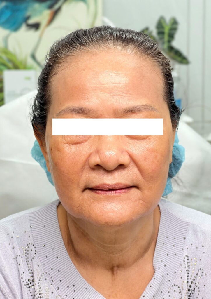Hình ảnh minh họa lão hóa da toàn mặt và trị lão hóa theo phương pháp của Lona Skin Lab