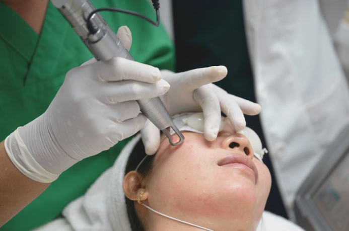 trị rạn da trắng - Bắn laser theo liều phù hợp cho da