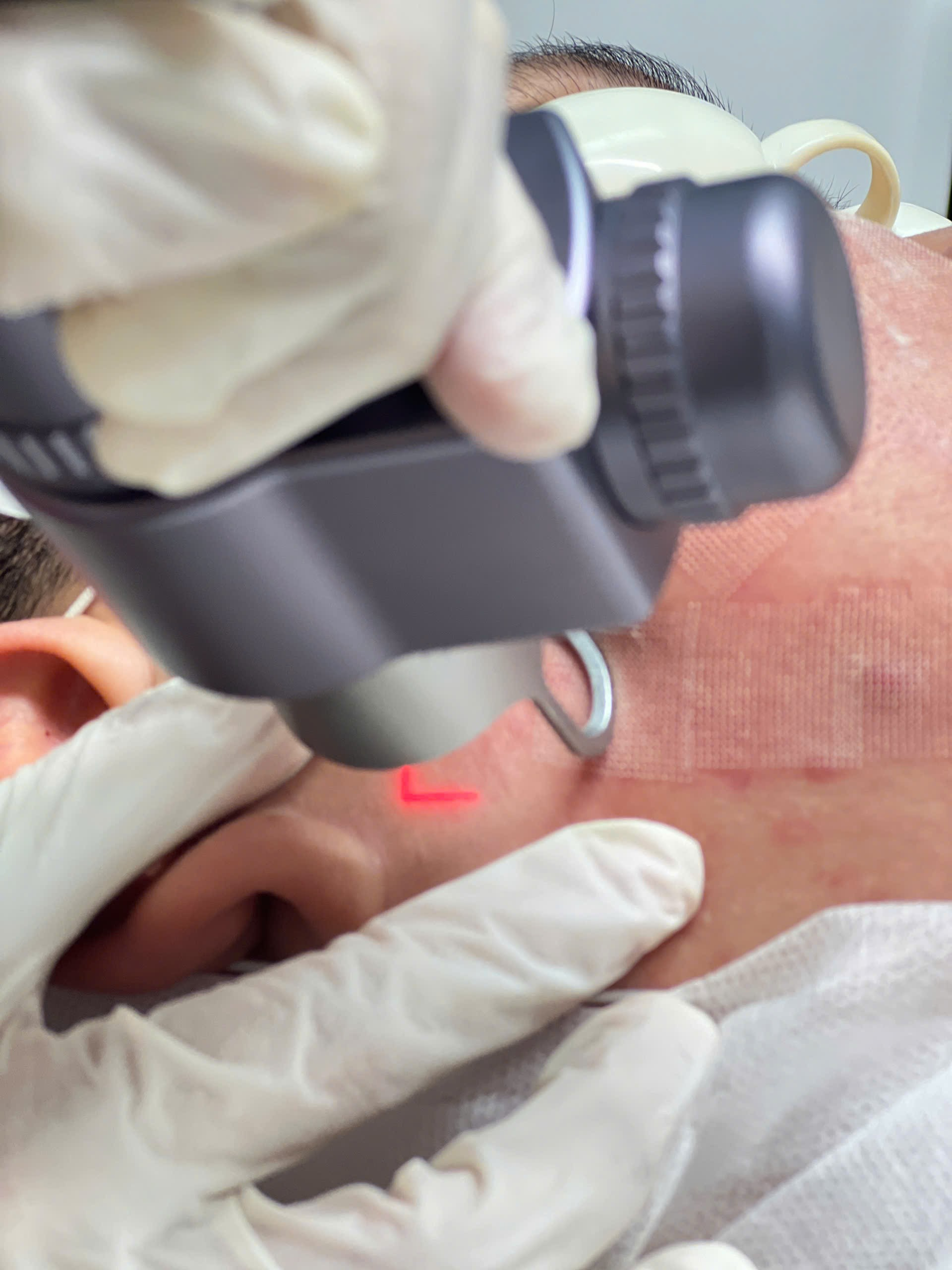 trị rạn da trắng - Chăm sóc da hiệu quả sau laser