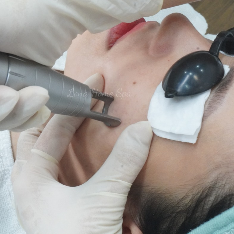trị rạn da trắng - Điều chỉnh liều năng lượng laser cho da