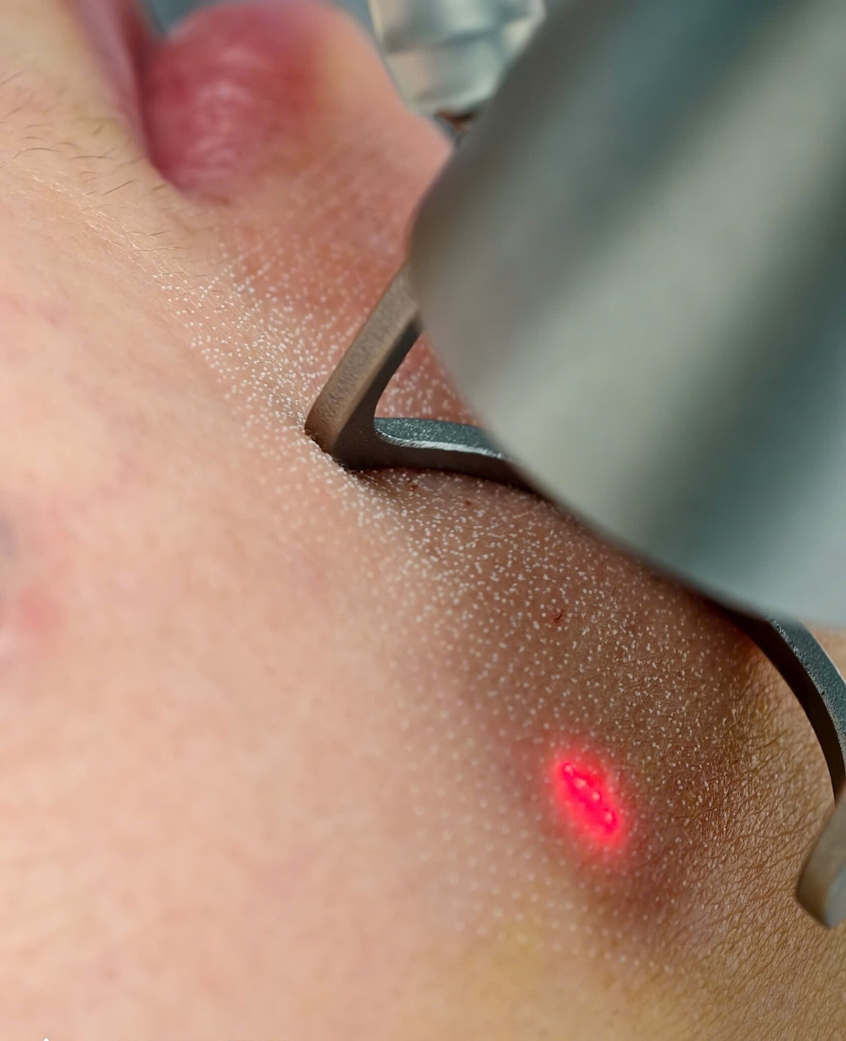 Với Laser CO2 Fractional, các bác sĩ chuyên khoa da liễu tiên phong áp dụng công nghệ laser CO2 trong điều trị sẹo chân đinh, qua đó hỗ trợ trị sẹo rỗ và mang lại hiệu quả tối ưu tại Laser CO2 Fractional Cần Thơ.
