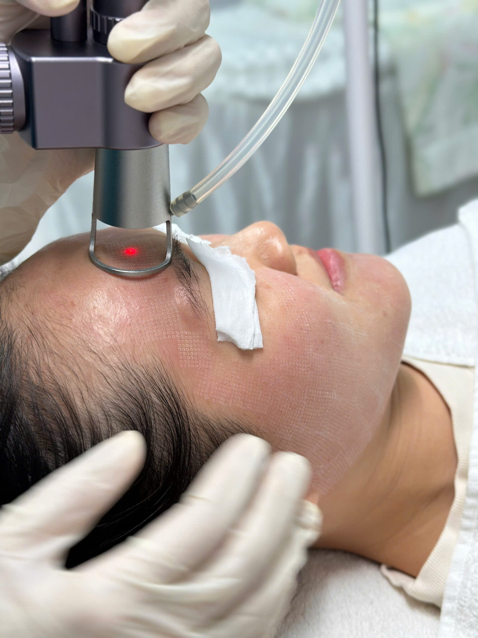 Điều trị giãn mao mạch tại Cần Thơ - Giãn mao mạch biểu hiện rõ trên da