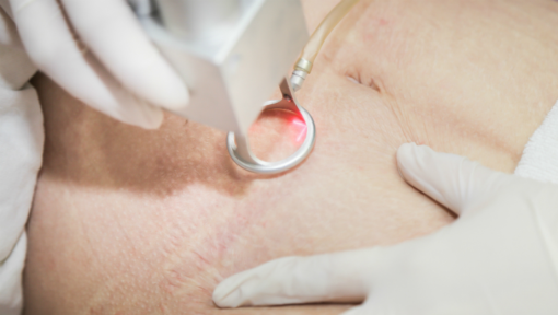 Quy trình trị liệu kết hợp trong điều trị da với công nghệ laser hiện đại