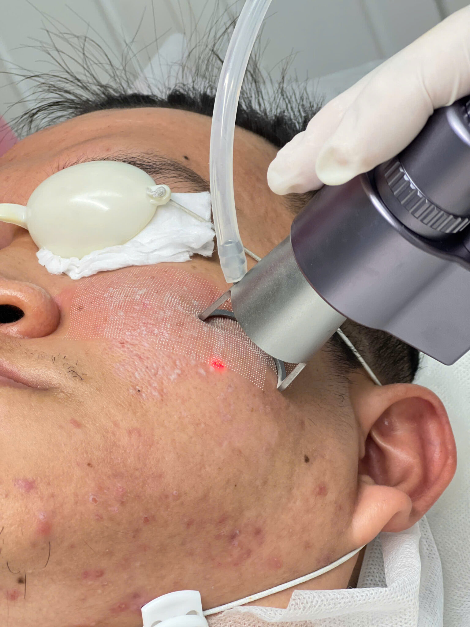 Trong bối cảnh sử dụng Laser CO2 Fractional tiên tiến, công nghệ laser CO2 được ứng dụng để điều trị sẹo chân đinh hiệu quả, giúp trị sẹo rỗ và tái tạo da một cách toàn diện qua Laser CO2 Fractional Cần Thơ.