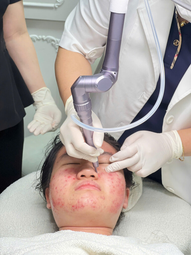 Hình ảnh này chứng tỏ sự ưu việt của Laser CO2 Fractional kết hợp với CO2 fractional mụn chai trong điều trị mụn thịt, khi công nghệ laser CO2 hiện đại được sử dụng hiệu quả để trị sẹo rỗ và cải thiện vùng da tổn thương.