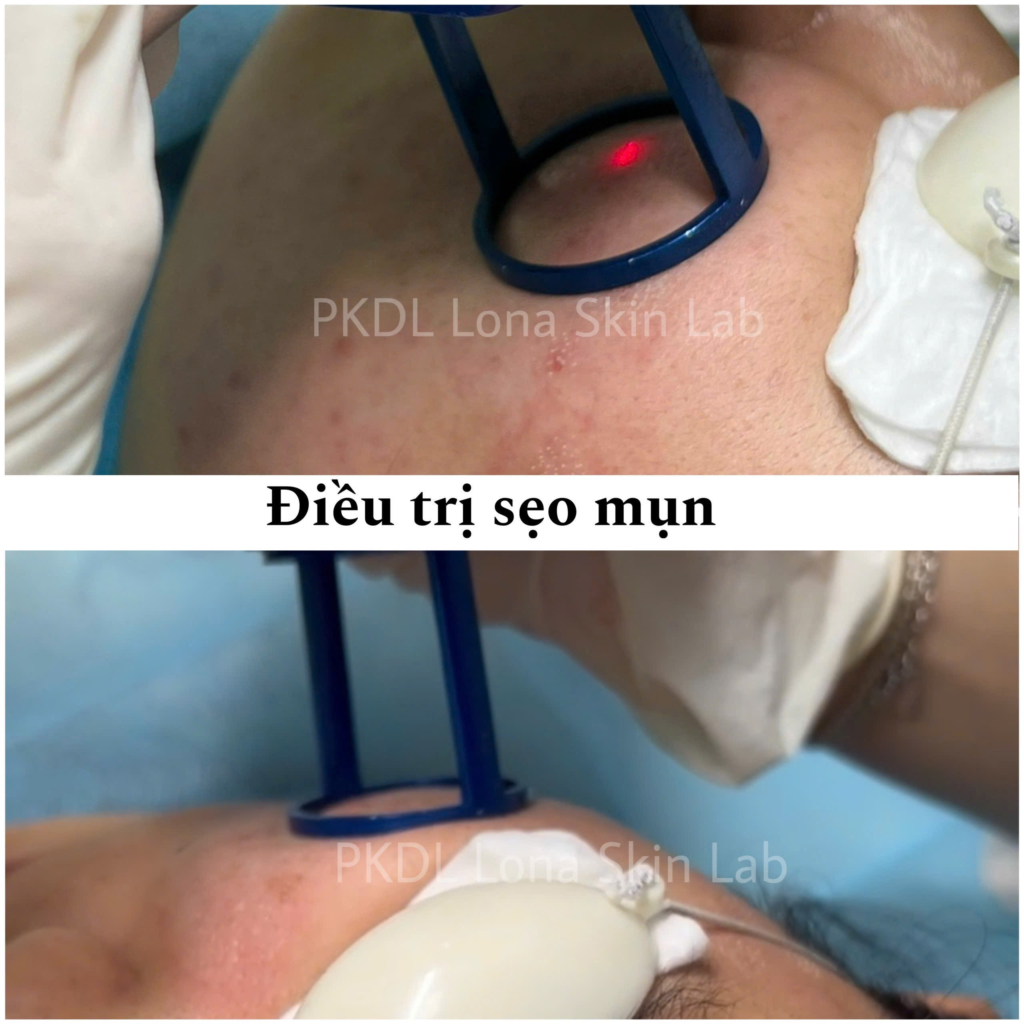 Phương pháp điều trị giãn mao mạch qua laser giúp cải thiện triệu chứng giãn mao mạch và kiểm soát giãn mao mạch ở mặt.