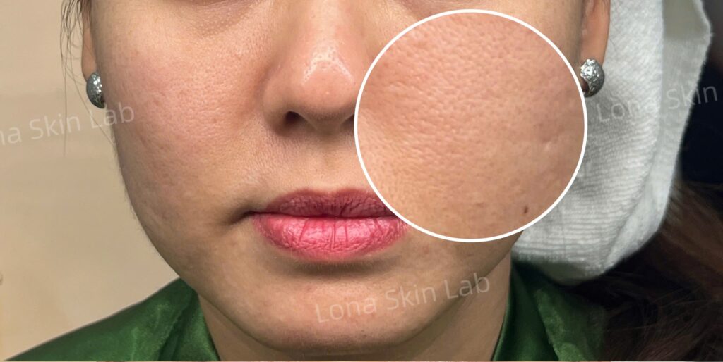 Hình ảnh minh họa quy trình triệt lông mặt hiện đại với công nghệ laser và IPL, thể hiện triệt lông mặt hiệu quả và an toàn tại Lona Skin Lab.