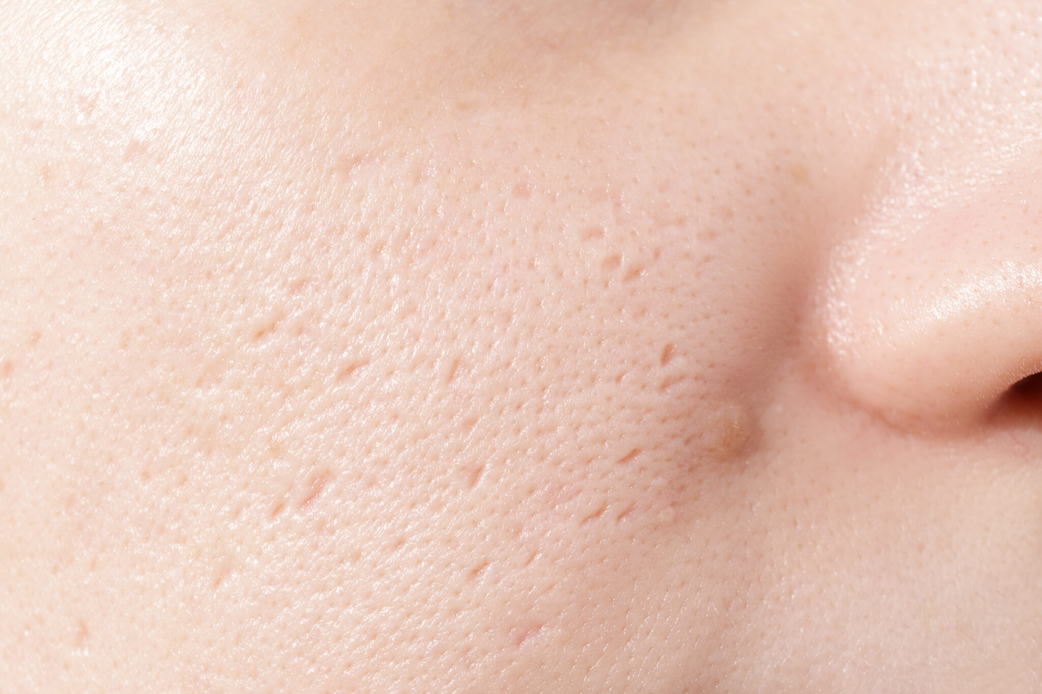 Thu nhỏ lỗ chân lông, lỗ chân lông, thu nhỏ lỗ chân lông, skincare, lona.vn, chăm sóc da