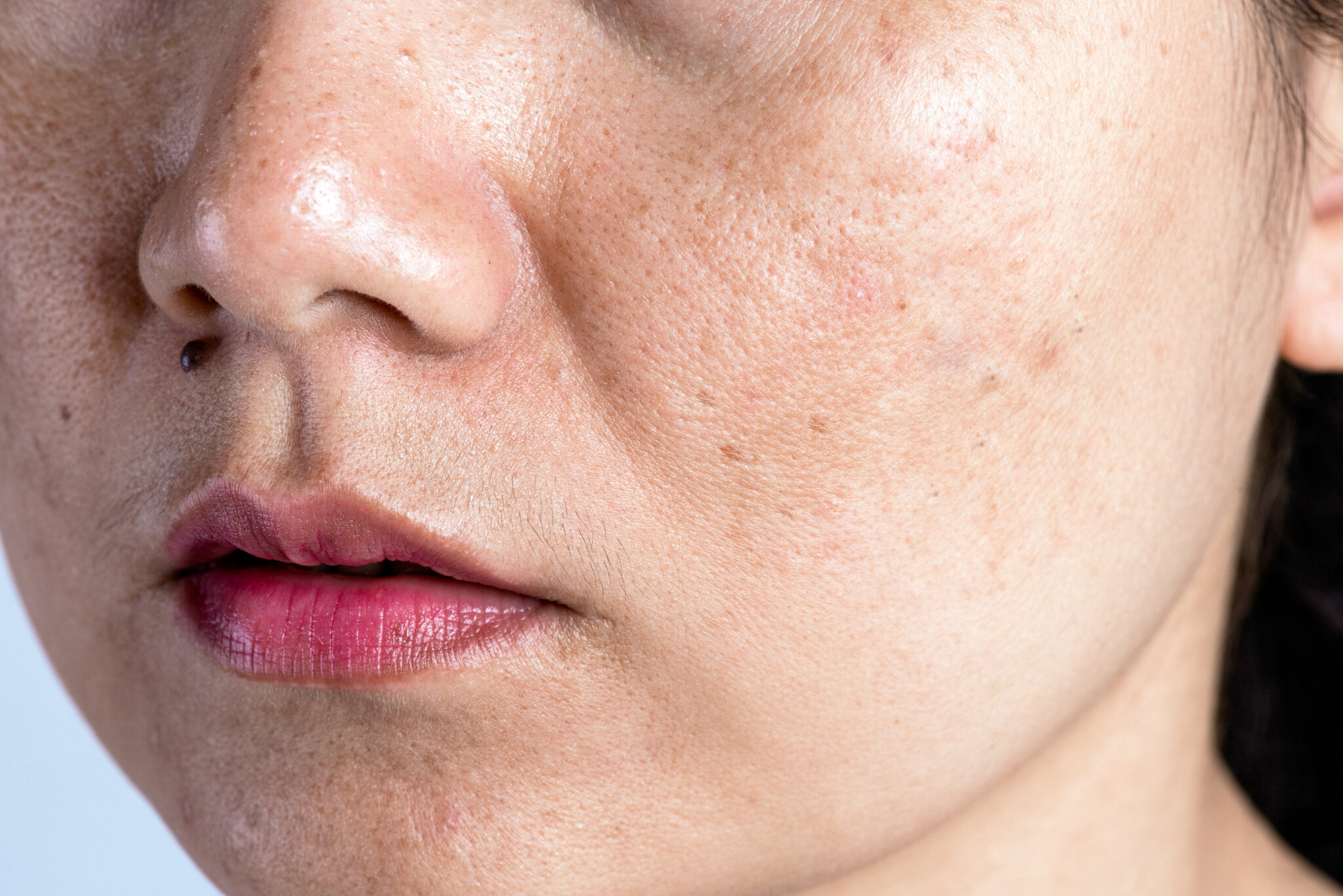 Thu nhỏ lỗ chân lông, lỗ chân lông, thu nhỏ lỗ chân lông, skincare, lona.vn, chăm sóc da