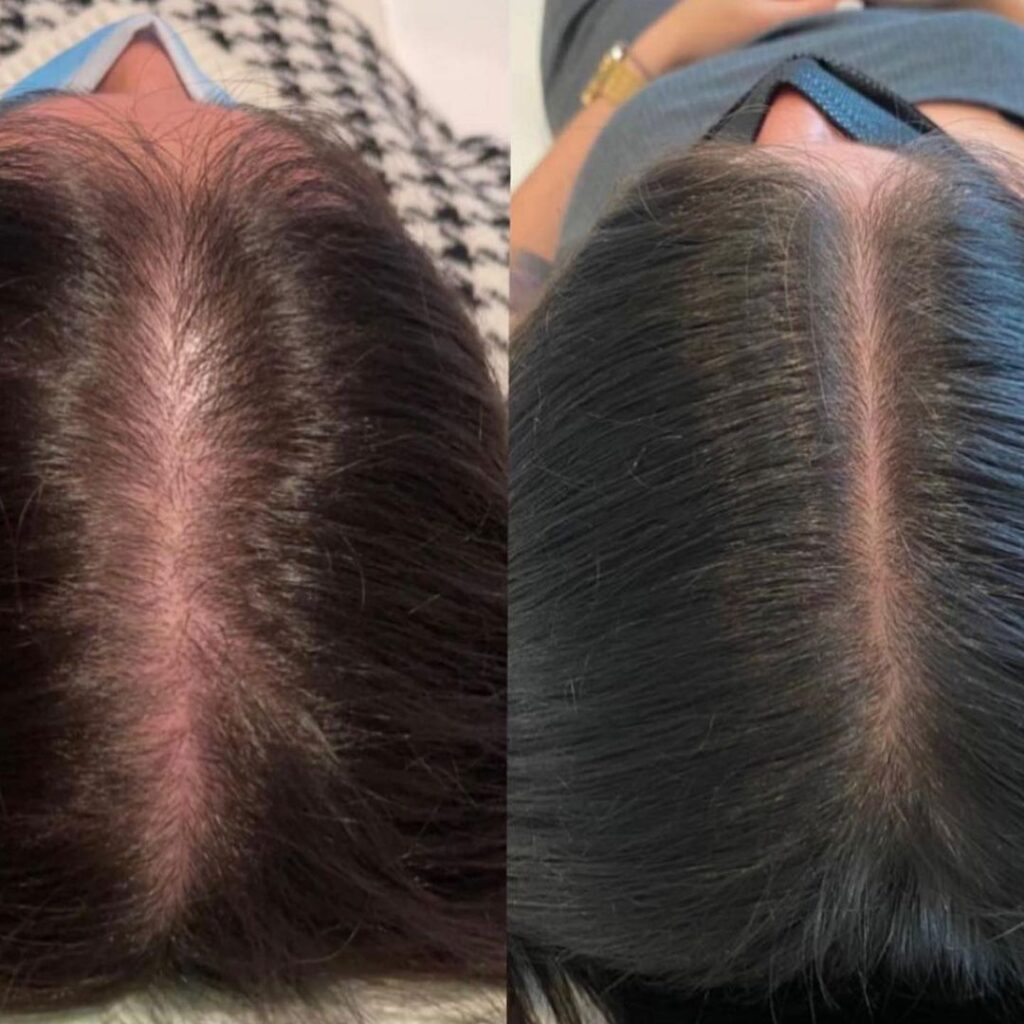 mesotherapy không hiệu quả, mesotherapy, tiêm meso, làm đẹp, tái tạo da, Lona Skin Lab
