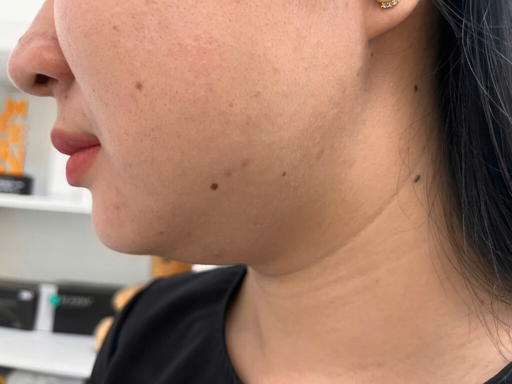 Hình ảnh được chụp trong khuôn khổ triệt lông mặt hiện đại tại Lona Skin Lab thể hiện triệt lông mặt hiệu quả và triệt lông mặt an toàn, đảm bảo dịch vụ triệt lông mặt hoàn hảo cho khách hàng.