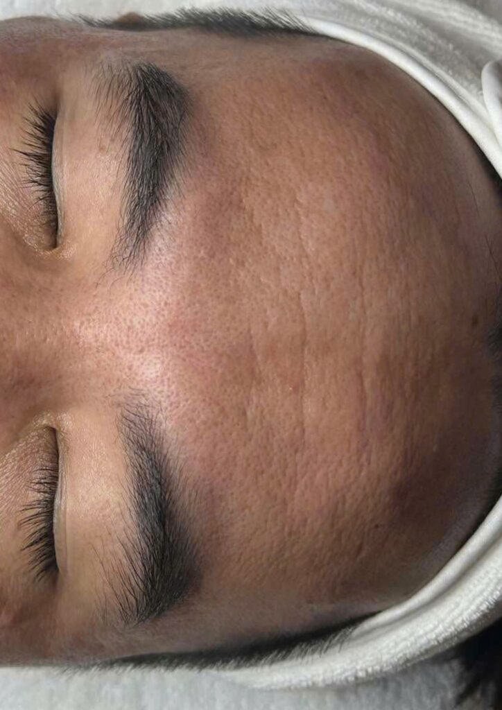 Hình ảnh minh họa quá trình chăm sóc và điều trị lão hóa da toàn mặt tại Lona Skin Lab