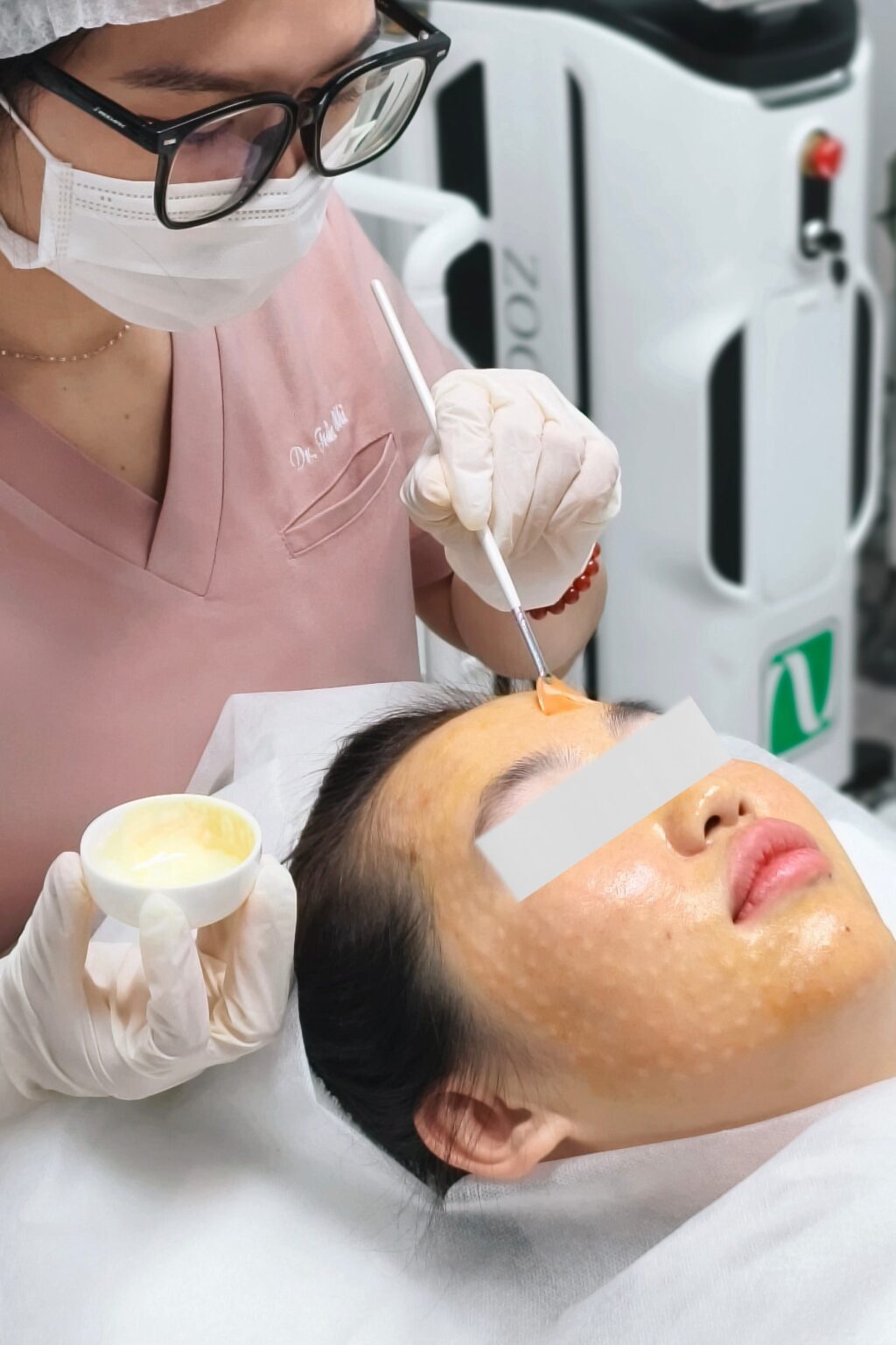 Ảnh này thể hiện quy trình peel da TCA được thực hiện tại Lona Skin Lab, trong đó phương pháp peel da hỗ trợ peel da trị sẹo nhằm đạt hiệu quả trị sẹo hiệu quả cho bệnh nhân.