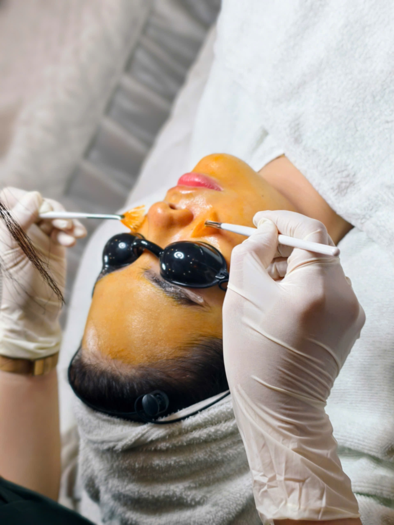 Hình ảnh minh họa cho Peel da trị mụn Cần Thơ và peel da trị mụn chuẩn y khoa tại Cần Thơ