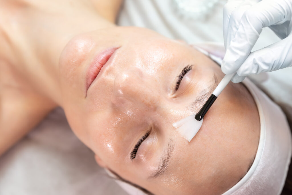 Quy trình peel da trị mụn Cần Thơ minh họa hiệu quả của peel da trị mụn chuẩn y khoa tại Cần Thơ