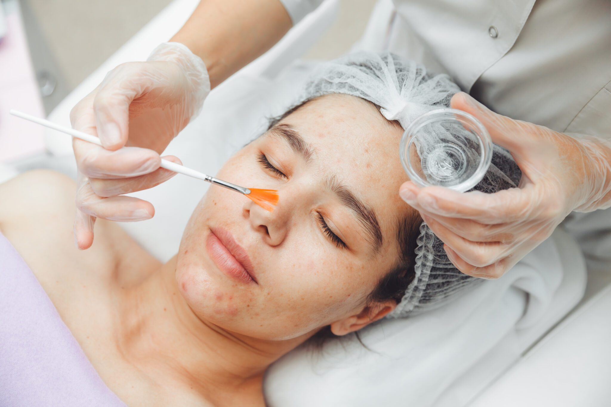Ảnh minh họa peel da TCA cho quy trình peel da trị sẹo tại Lona Skin Lab, khẳng định hiệu quả của phương pháp peel da trong việc trị sẹo hiệu quả.
