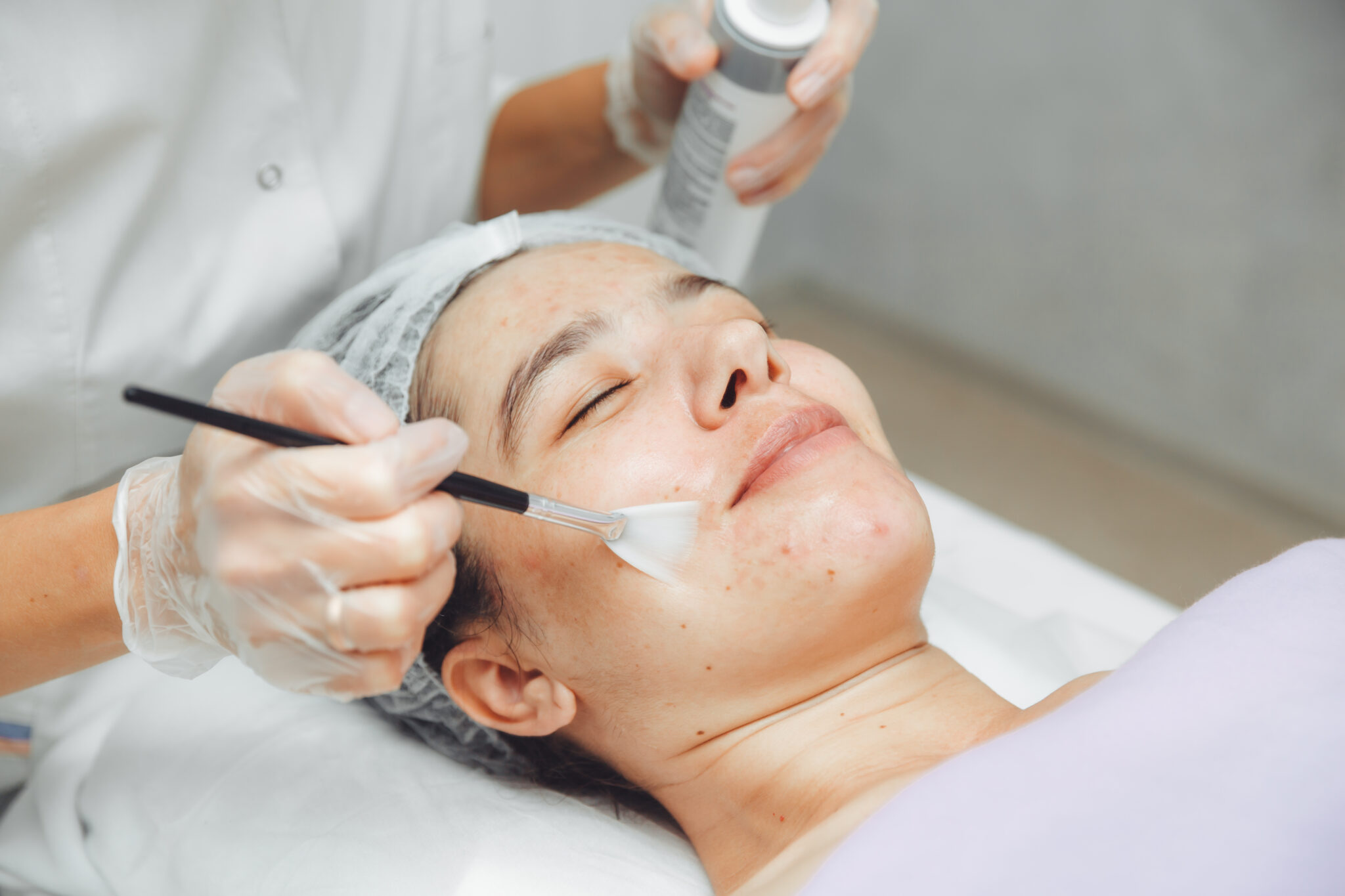 Trong bức ảnh này, peel da TCA được áp dụng như một phần của phương pháp peel da nhằm mang lại kết quả trị sẹo hiệu quả, đồng thời Lona Skin Lab ghi nhận vai trò của peel da trị sẹo trong điều trị chuyên sâu.
