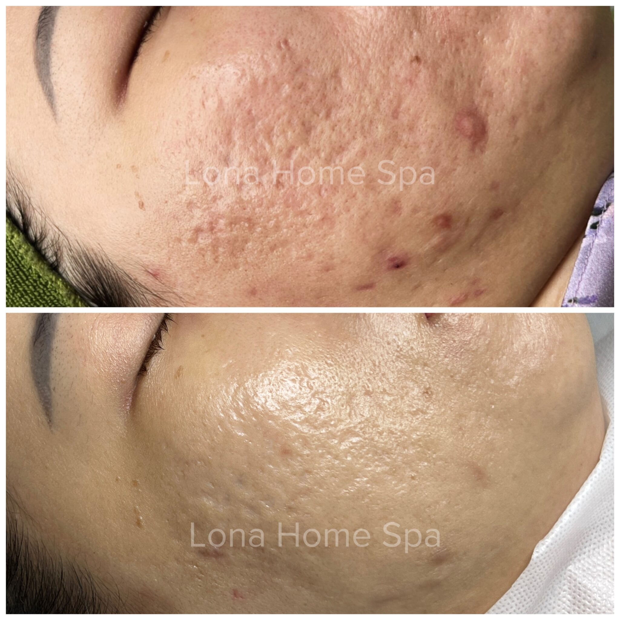 thẩm mỹ xóa rãnh cười - quyết định điều trị
