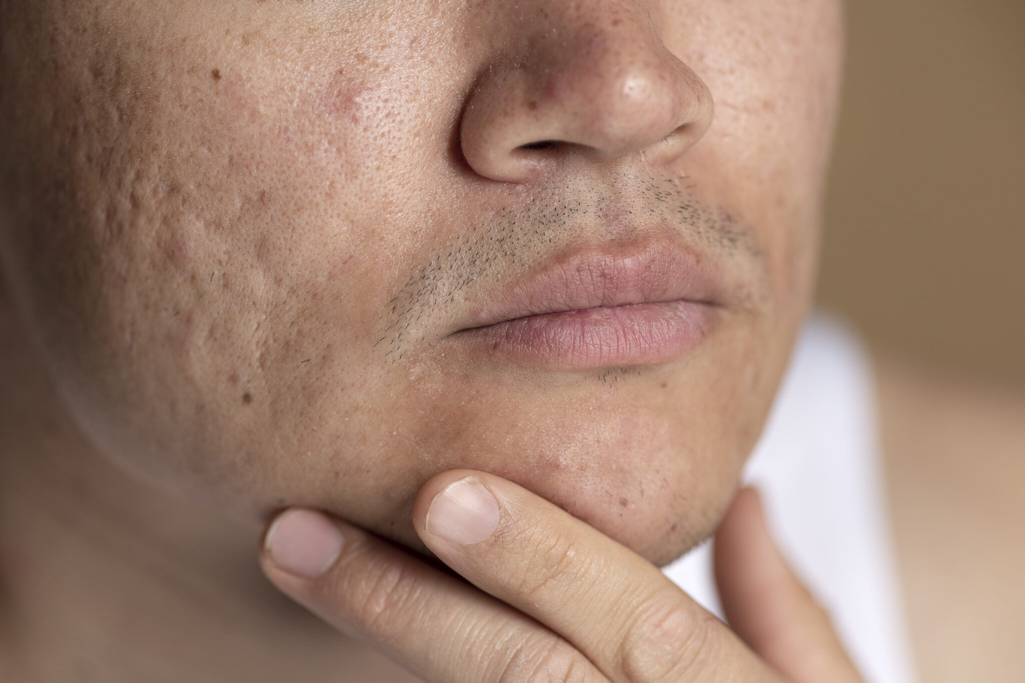 Cơ chế hoạt động của bóc tách đáy sẹo giúp kích thích collagen.