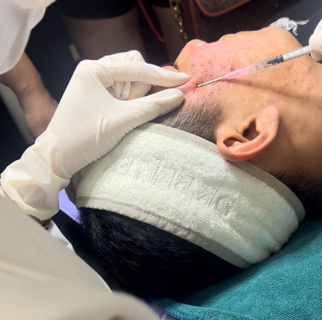 Phương pháp bóc tách đáy sẹo giúp cải thiện da và điều trị sẹo rỗ hiệu quả.