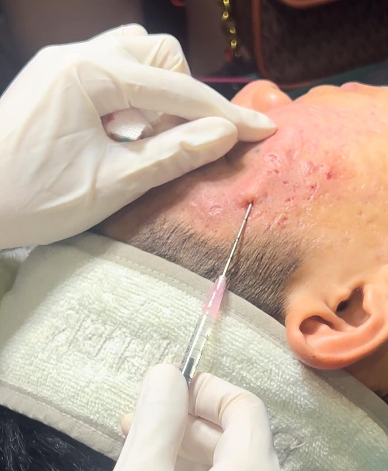 Kỹ thuật bóc tách đáy sẹo kết hợp điều trị sẹo rỗ đạt hiệu quả cao.