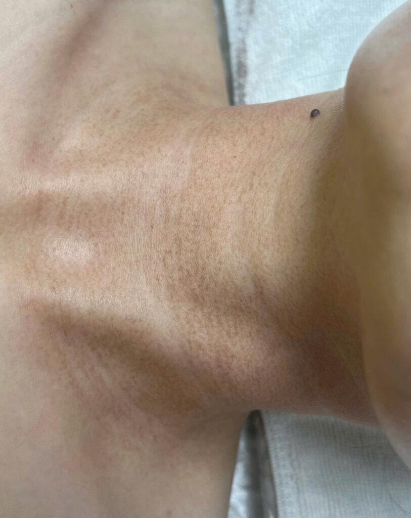 Rãnh cười sâu - filler - Lona Skin Lab